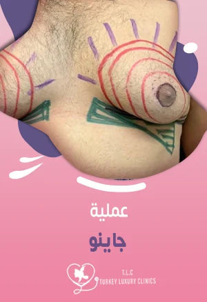 عملية جاينو: الأعراض والعلاج والأسعار في تركيا