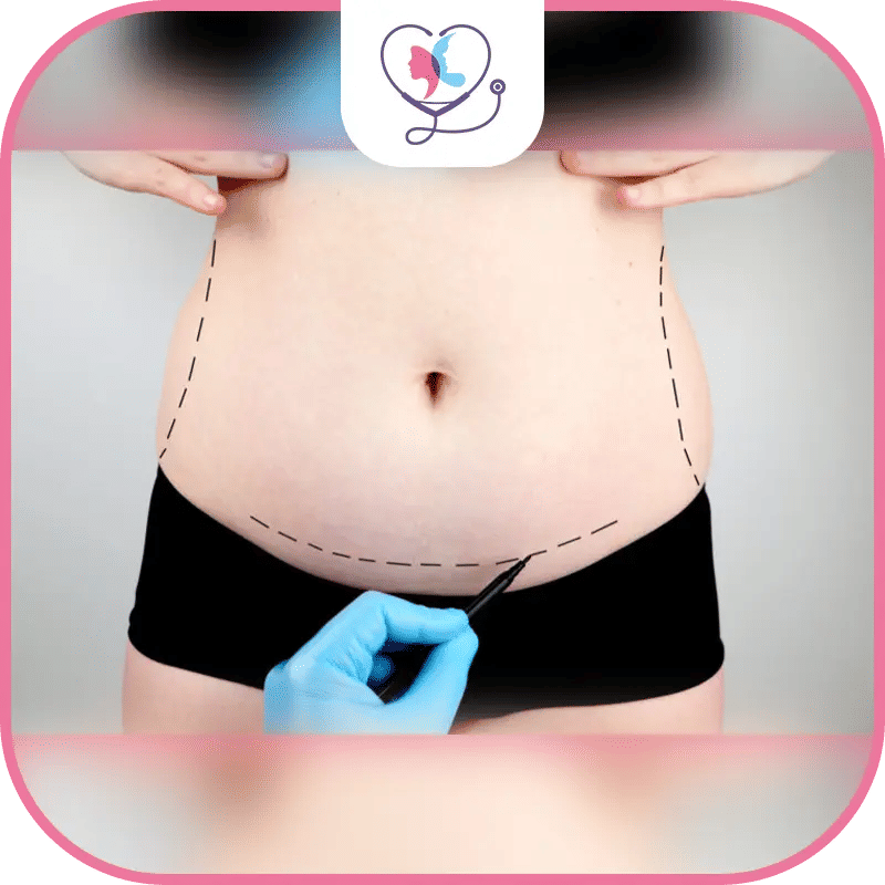 نصائح قبل عملية شد البطن