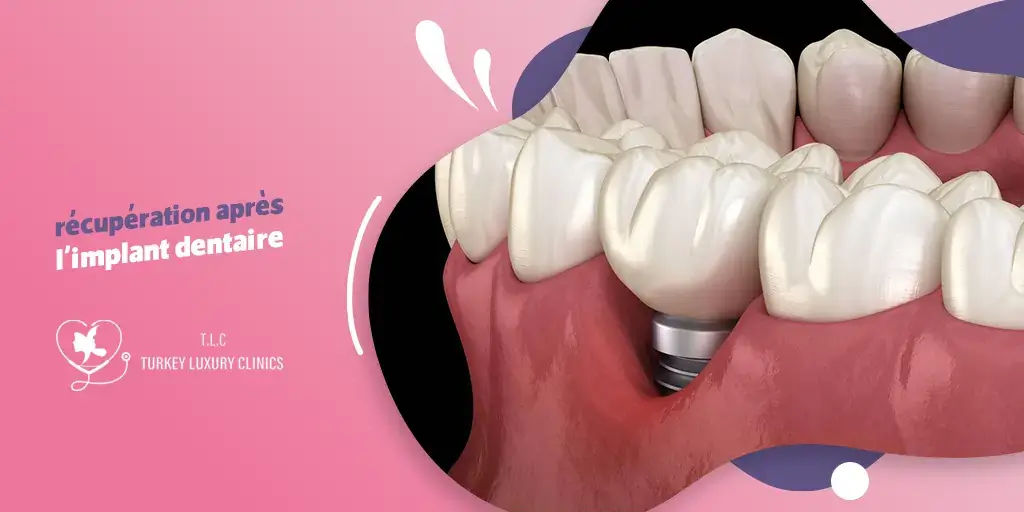 Convalescence après un implant dentaire