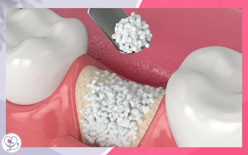 تطعيم العظم Bone grafting