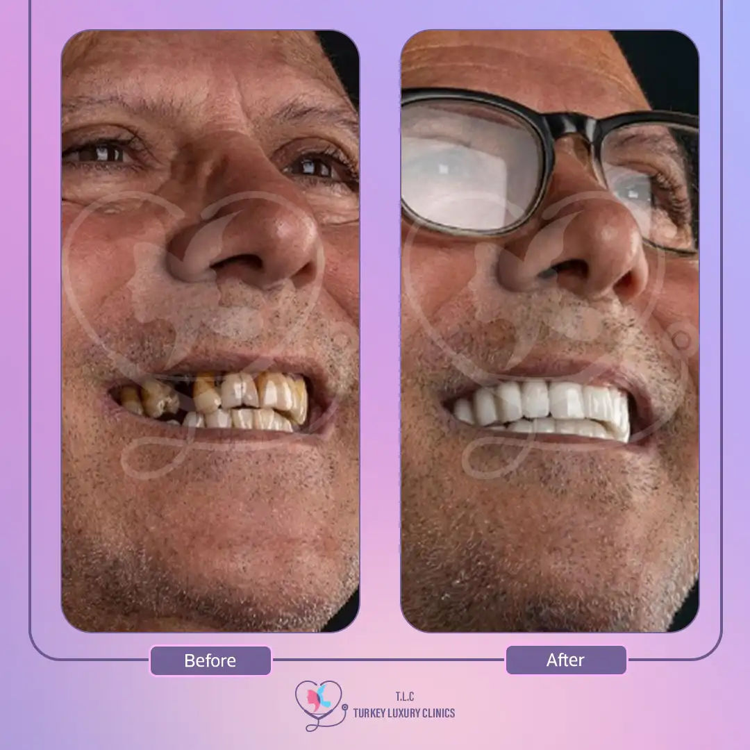 ثالثاً: ابتسامة هوليود ثري دي