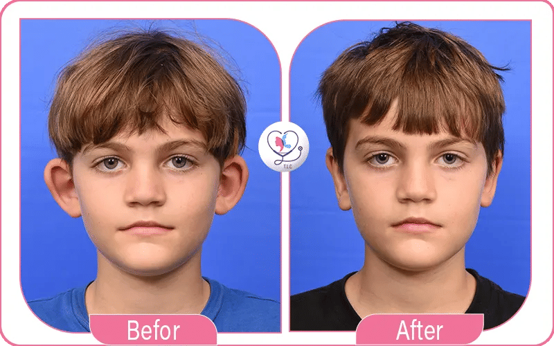 Otoplasty in Turkey Before and After