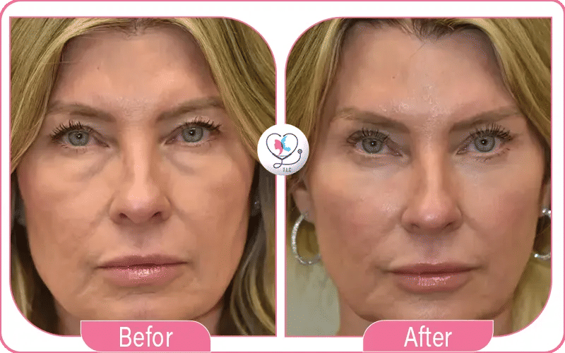 نتائج تجربتي مع رفع الحواجب بالبوتكس