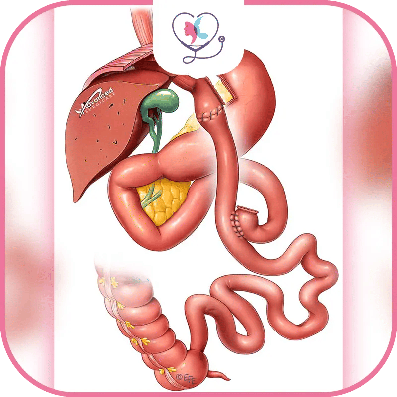 Le bypass est-il réversible ?