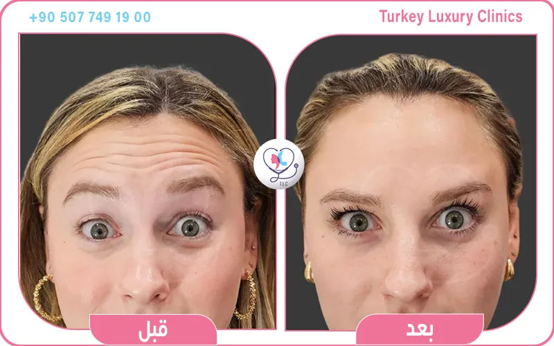 تجربتي مع الخلايا الجذعية للوجه