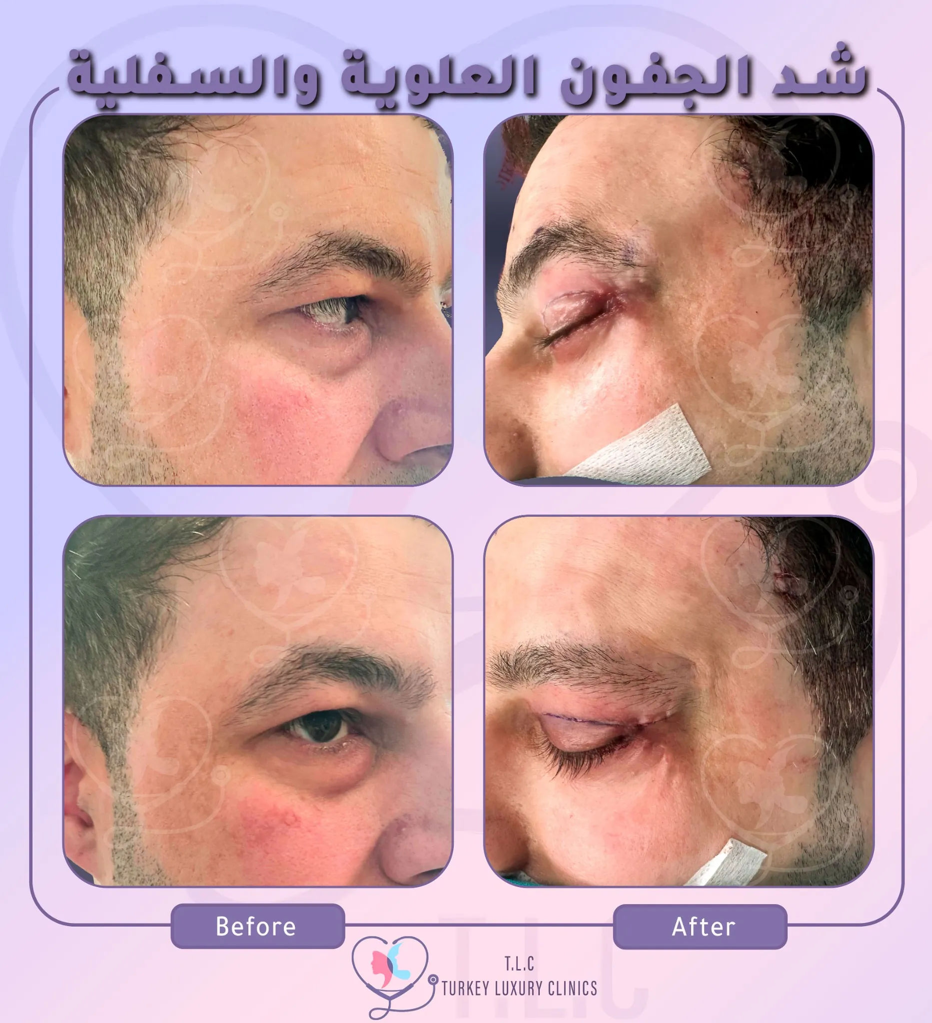 تكلفة عملية شد الجفون في تركيا