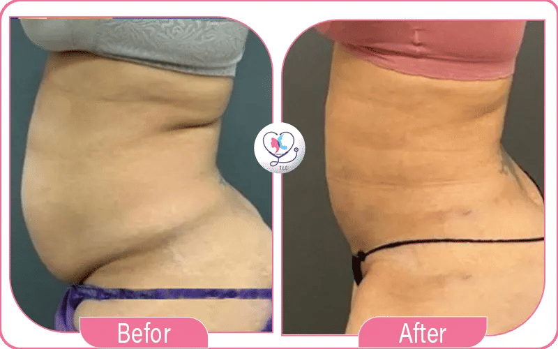 شفط دهون الظهر قبل وبعد