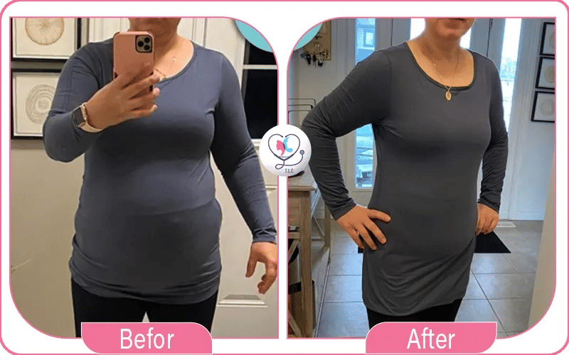 نتائج تجربتي مع بوتكس المعدة بالأرقام