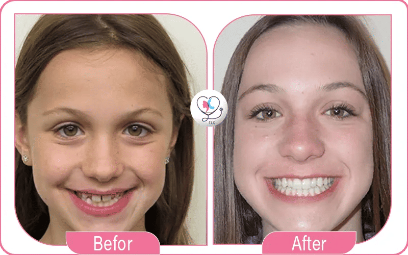 ما هو التقويم الشفاف؟