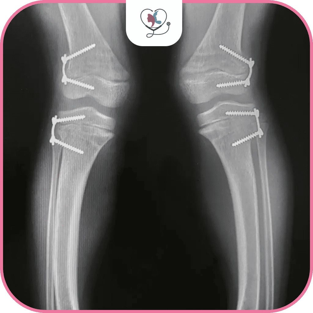 دليلك الشامل عن عملية تقوس الساقين في تركيا