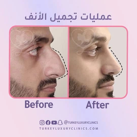 مدة بقاء خيوط الأنف