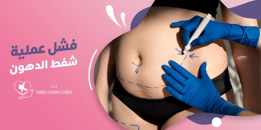 فشل عملية شفط الدهون