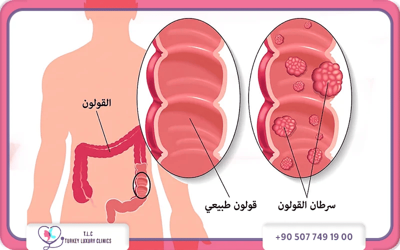 أنواع سرطان الأمعاء أنواع سرطان الأمعاء