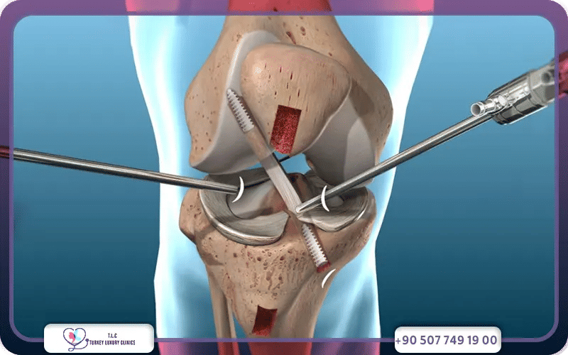 ما هي نسبة نجاح عملية الرباط الصليبي؟