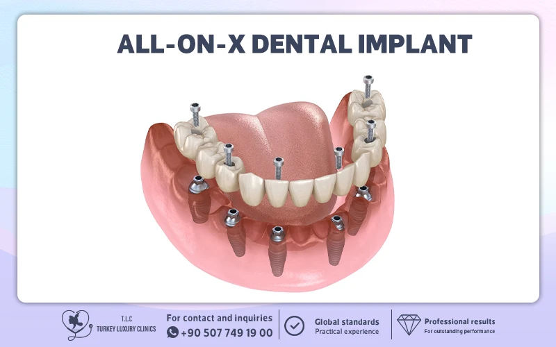 All-on-X Dental Implant