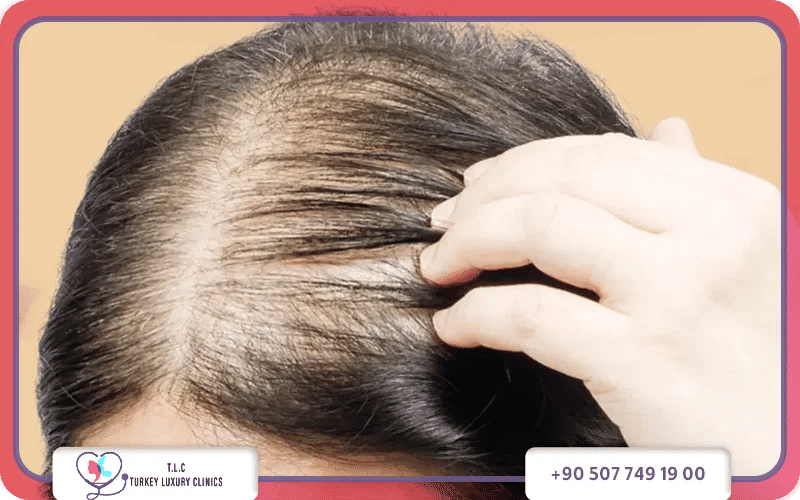 ما هو علاج فراغات الشعر؟