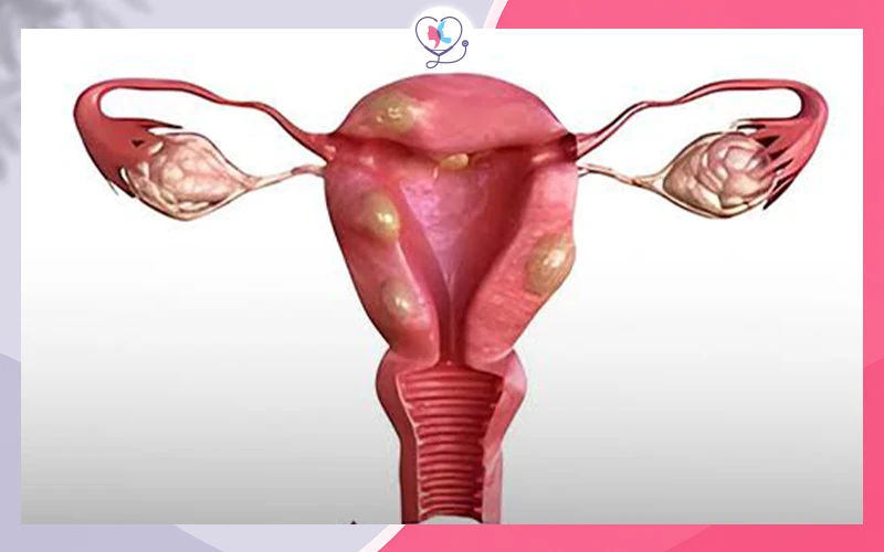 بطانة الرحم المهاجرة