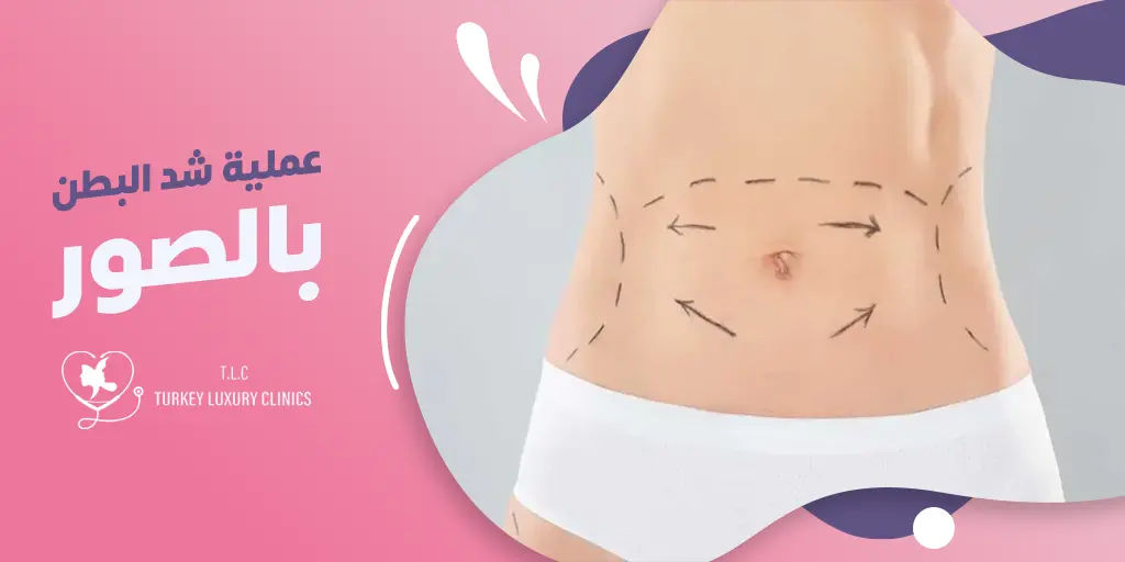 عملية شد البطن بالصور