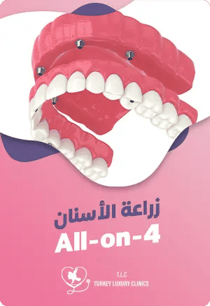زراعة الأسنان All-on-4featured image