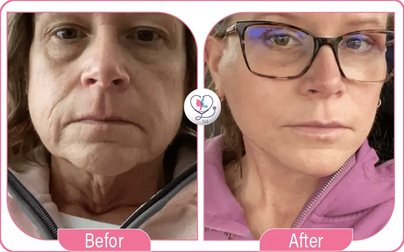 What to Expect Visually During Neck Lift Recovery Day by Day