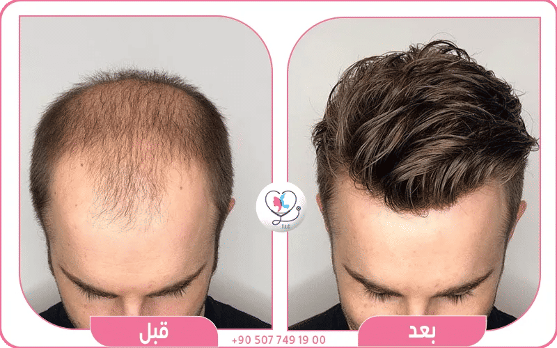 زراعة الشعر وعلاج الصلع الوراثي