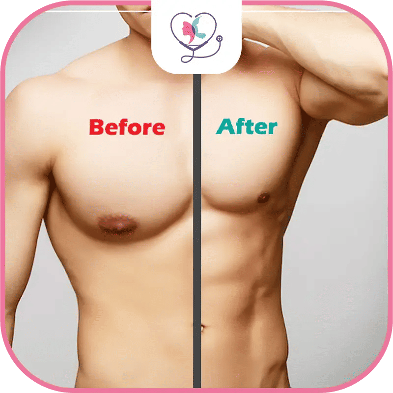 Résultats et suivi après la chirurgie de gynécomastie