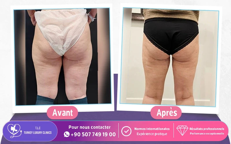 cruroplastie avant apres