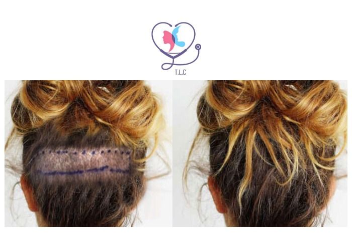 fenêtre de rasage - zone donneuse cachée