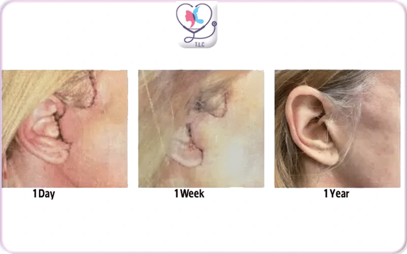 Localisation des Cicatrices après Mini Lifting du Visage-2