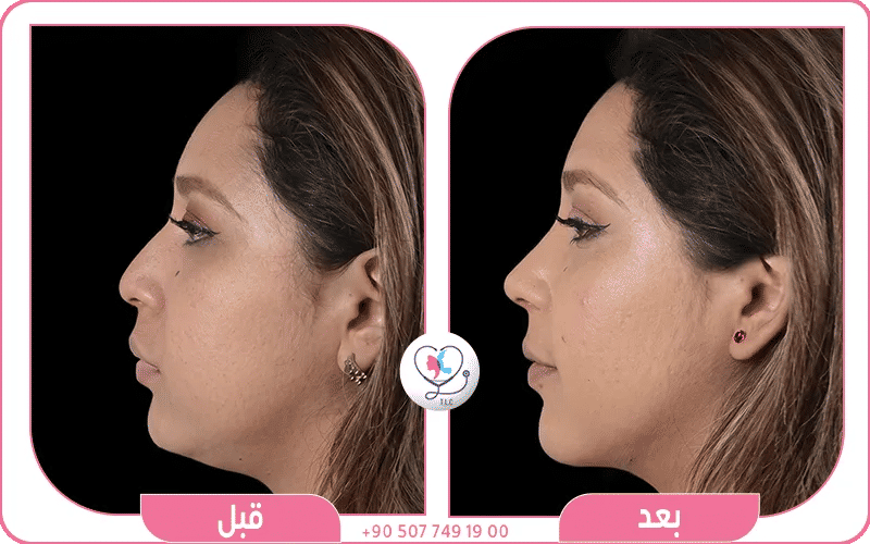 عملية ازالة دهون الخد
