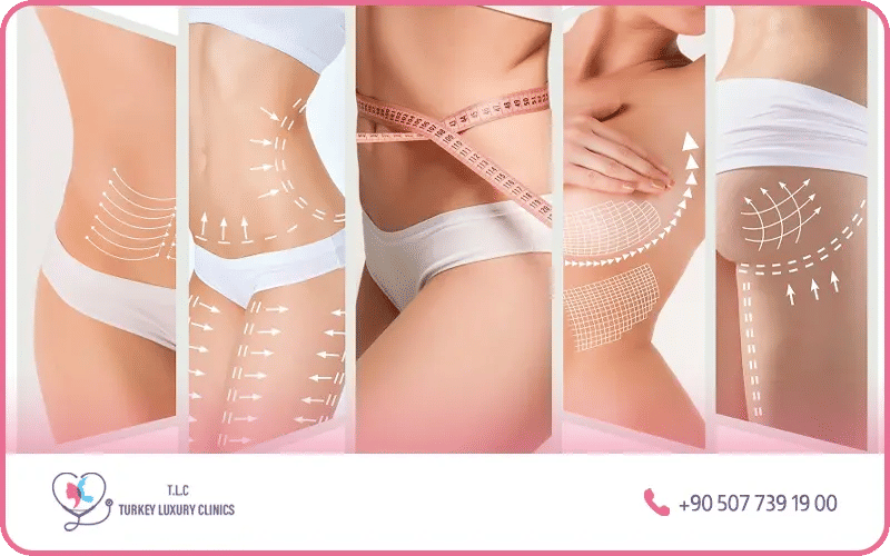 L’abdominoplastie et le bodylift 