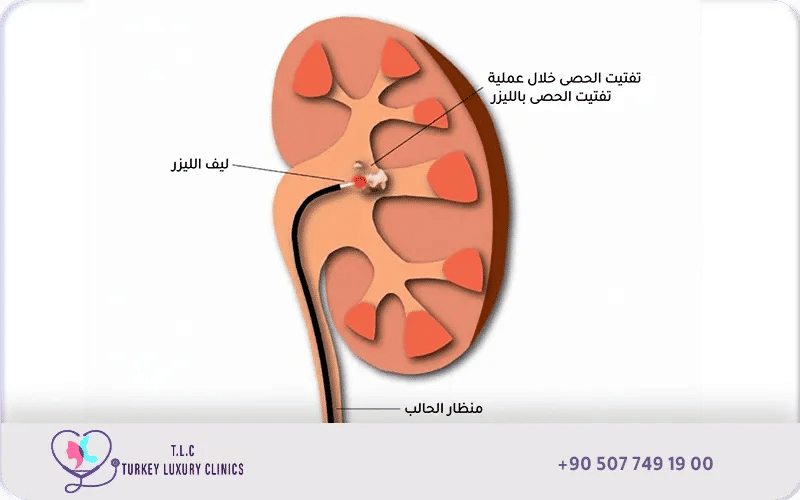 سعر عملية تفتيت حصى الكلى بالليزر