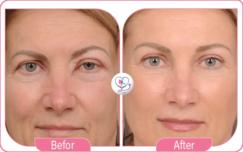 نحت الوجه قبل وبعد