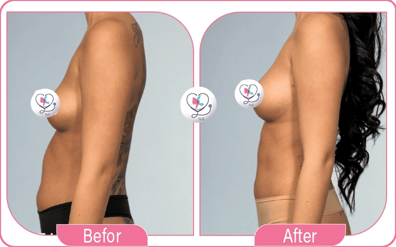 Avant / Après lipofilling mammaire du résultat du lipofilling mammaire-2