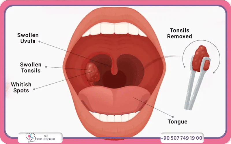What is a Tonsillectomy and Adenoidectomy?