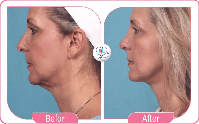 Mini Neck Lift Before and After Pictures 2