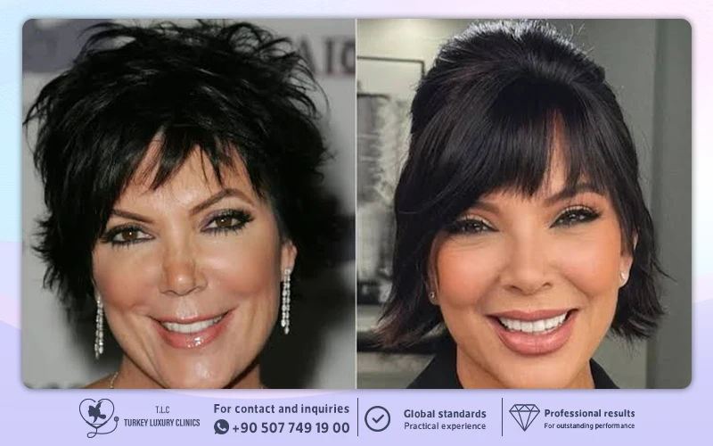 Kris Jenner Face Lift Before and After