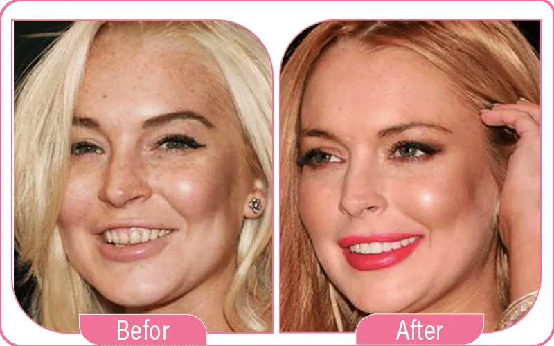 Lindsay Lohan Facelift Rumors