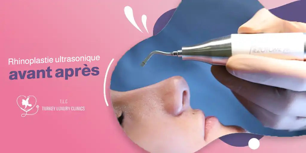 Rhinoplastie ultrasonique avant après: résultats naturels