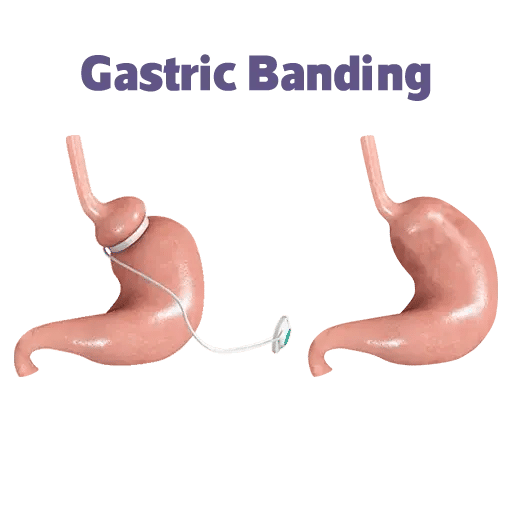 ماهي عملية ربط المعدة في تركيا؟