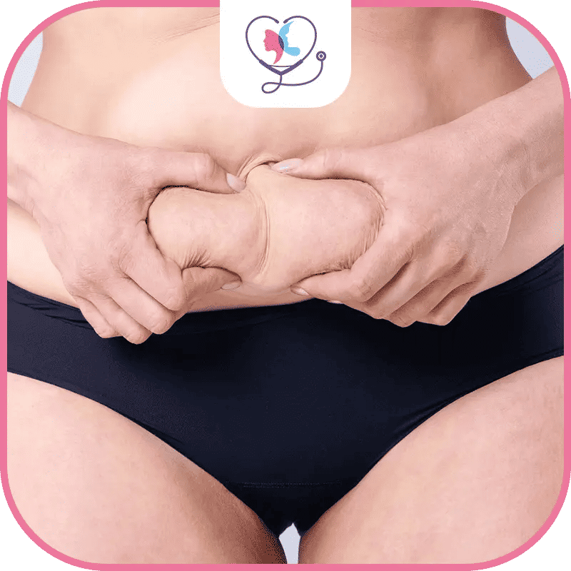 تجربتي مع عملية شد البطن