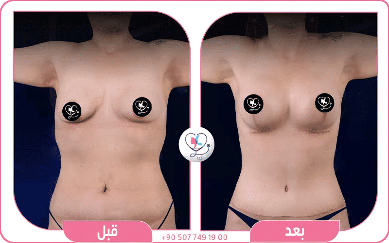 تجارب ناجحة لتكبير الثدي لدى تركيا لاكشري كلينك