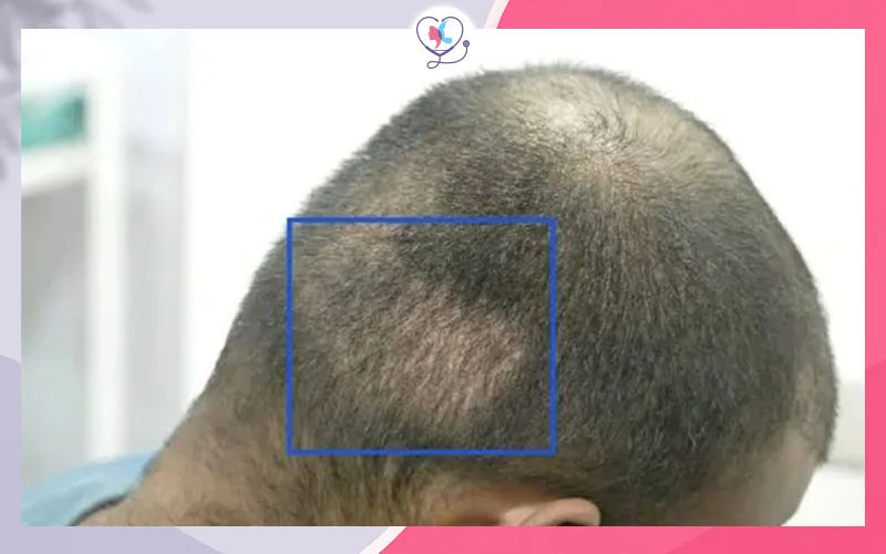ظهور فراغات في المنطقة المانحة