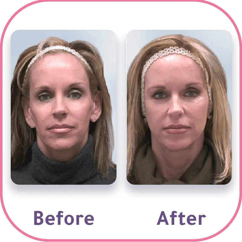 من هو المرشح المناسب لحقن الفيلر؟