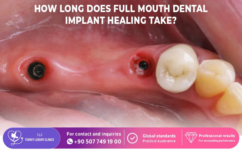 How Long Does Full Mouth Dental Implant Healing Take?