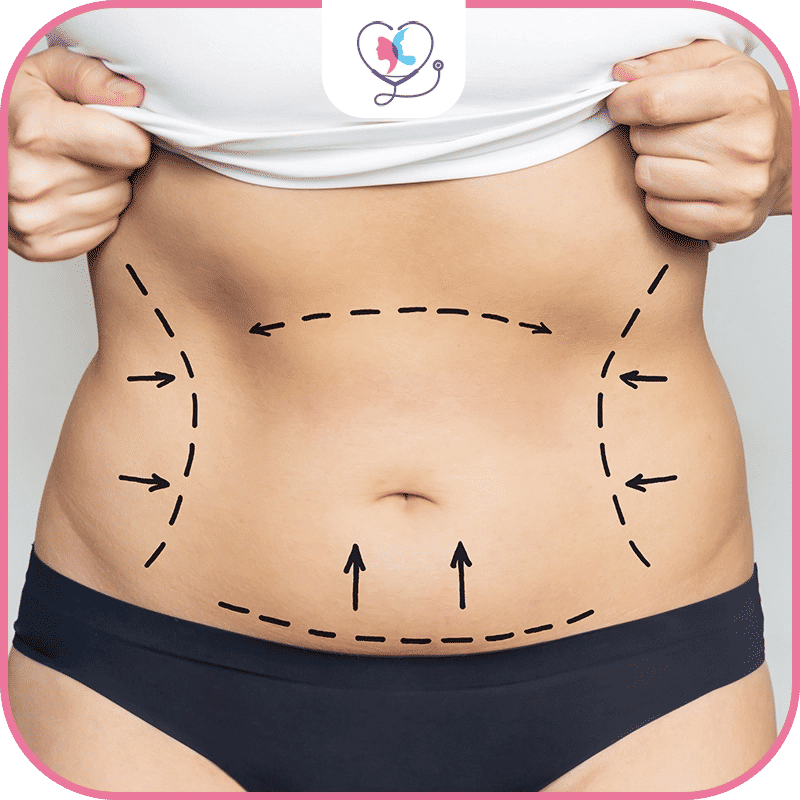 liposuccion tumescente turquie - liposuccion tumescente photos- liposuccion tumescente chevilles