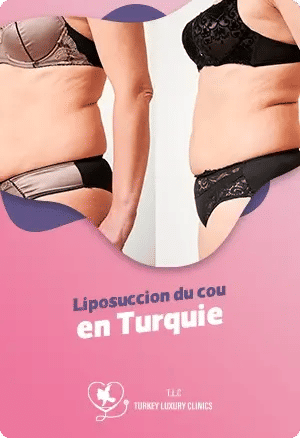Liposuccion du cou en Turquie