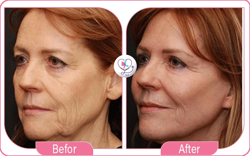 lipofilling visage avant et après