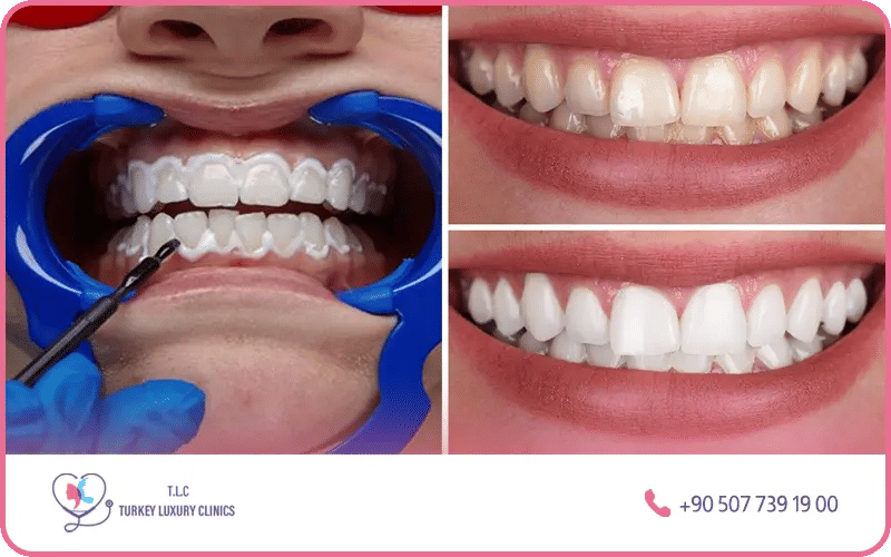 Teeth whitening Turkey before and after – dramatic smile transformation results at Turkey Luxury Clinics Istanbul