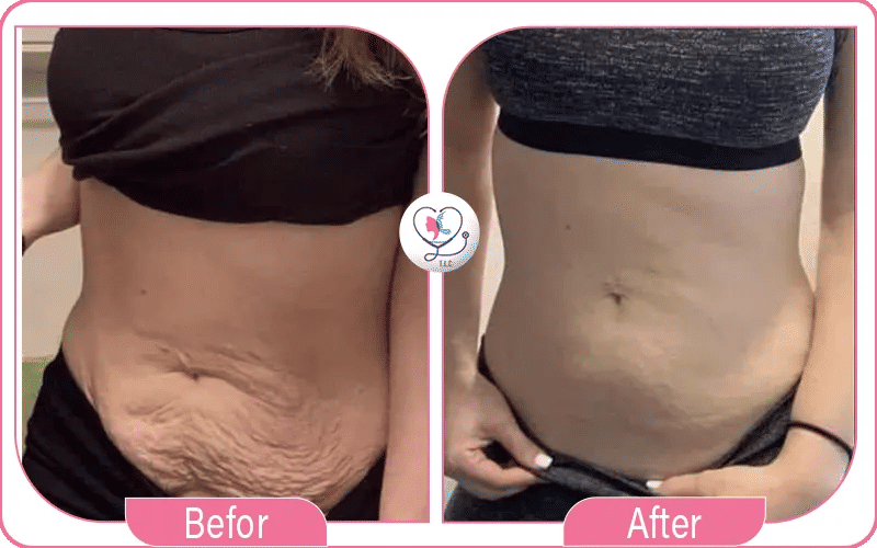 Long Term Tummy Tuck Belly Button Healing Phase